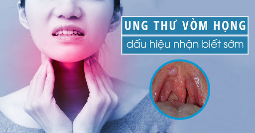 Thiếu niên 15 tuổi bị sưng tấy ở cổ, đến bệnh viện được chẩn đoán ung thư vòm họng, đừng bỏ qua 6 dấu hiệu bệnh ở giai đoạn đầu - Ảnh 2.