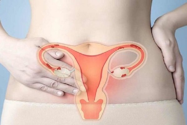 Ung thư cổ tử cung gây tử vong cao thứ 3 ở phụ nữ: Dấu hiệu cảnh báo, người có nguy cơ cao mắc phải và các giai đoạn phát triển bệnh - Ảnh 2.