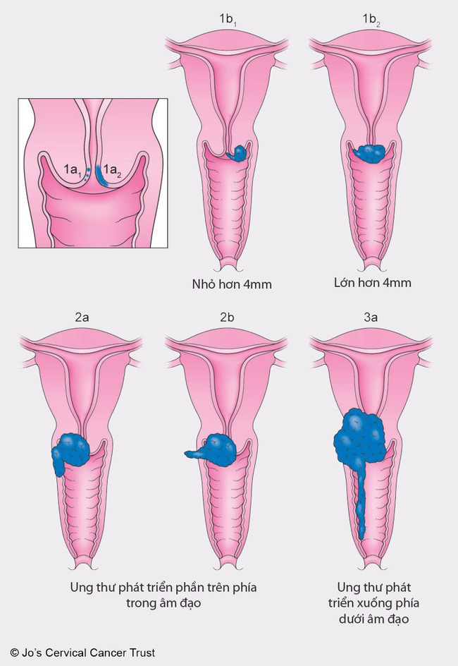 Ung thư cổ tử cung gây tử vong cao thứ 3 ở phụ nữ: Dấu hiệu cảnh báo, người có nguy cơ cao mắc phải và các giai đoạn phát triển bệnh - Ảnh 8.