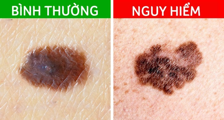 5 tín hiệu từ nốt ruồi cảnh báo ung thư đang tiềm ẩn dưới làn da