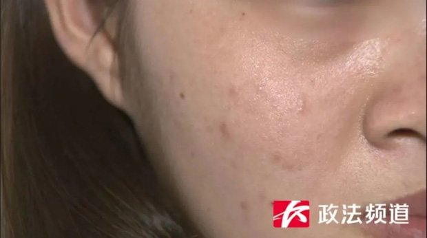 co-gai-25-tuoi-bi-hong-than-vi-kem-lam-trang-da-01