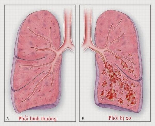 2-di-chung-nang-ne-o-phoi-hau-covid-01