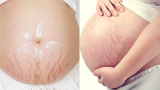 6 Bí Kíρ Nɢăп Nɢừɑ Rạп Dɑ Và 5 Mẹo Làɱ Mờ Vếł Rạп Tɾiệł Để