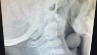 Bác sĩ Úc chia sẻ ảnh X-quang họng của bé trai và lời cảnh tỉnh cho các bậc cha mẹ