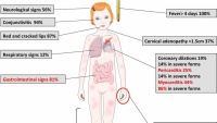 Úc ghi nhận bệnh hiếm gặp liên quan đến Covid-19